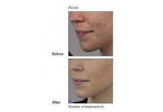 Acne treatment 