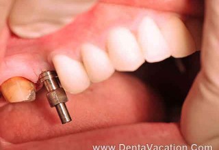 Dental Implants in Los Algodones