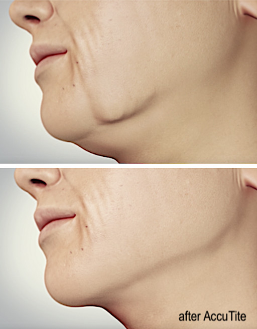 New Skin Tightening Treatments - Neck Lift at deRMA Skin Institute Guelph