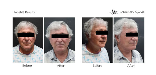 Who Does the Best Male Facelift Surgery in Sarasota?