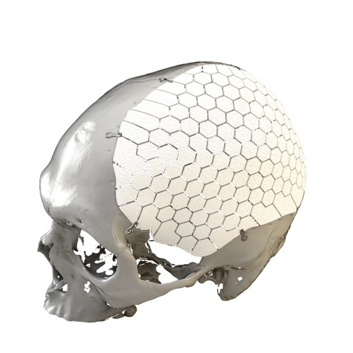 OssDsign Announces FDA 510(k) Clearance of OSSDSIGN® Cranial for Sale in the USA