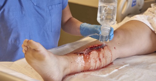 Ideal wound irrigation includes optimal pressure and uninterrupted stream of irrigant