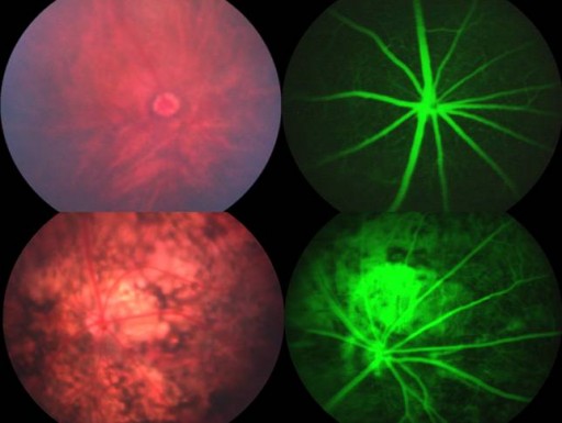 New Gene Linked To Blindness And Parkinson's Disease