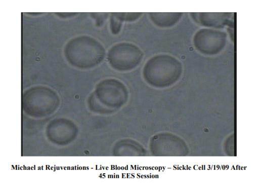 Rejuvenations Releases Preliminary Dark-Field Live Blood Microscopy Comparisons Around EESystem™ Exposure, Invites Controlled Replication
