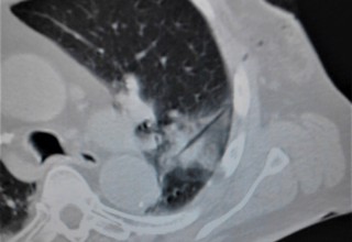 Lung tumor post microwave ablation treatment