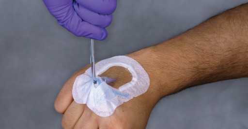 When it comes to peripheral intravenous catheter failure, securement matters