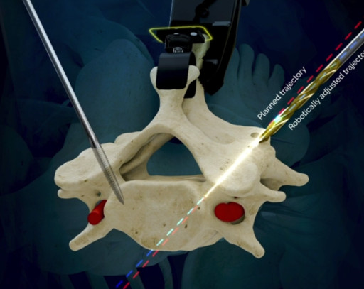 LEM Surgical Announces second FDA 510(k) Clearance for Next-Generation Humanoid Robotic Surgical System