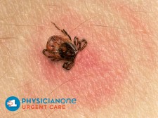 Tick bite and rash