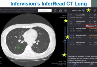 InferRead CT Lung