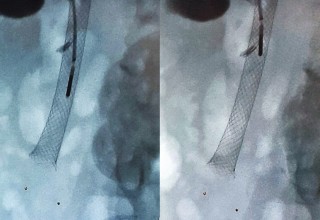 Microwave ablation in bile-duct stent