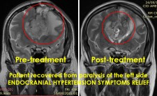 MR images of brain tumor pre- and post-microwave treatment