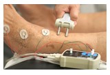 Performance of Nerve Conduction Study