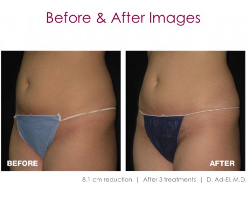 West Coast Plastic Surgery Is the First in Ventura County to Offer Breakthrough Non Invasive System for Fat Destruction