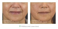 People who don't want to do surgery could consider a non-surgical way of tightening skin.