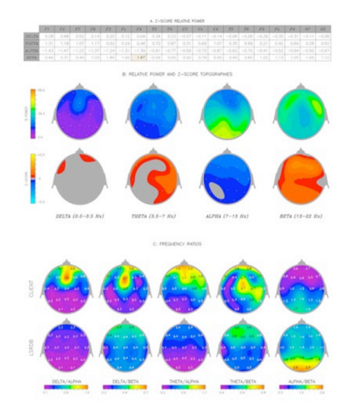 One-Hour Scalar Energy Session Shows Immediate Brainwave Normalization - New Hope for Anxiety, ADHD & Cognitive Disorders