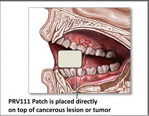 Clinical Trial Expected to Yield Promising Results for Oral Cancer Patients