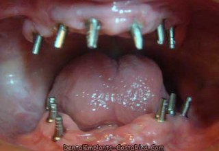 Dental Implant Treatment in Costa Rica